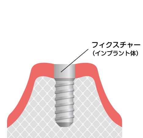 2次手術