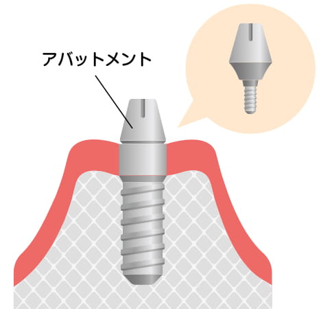 型取り