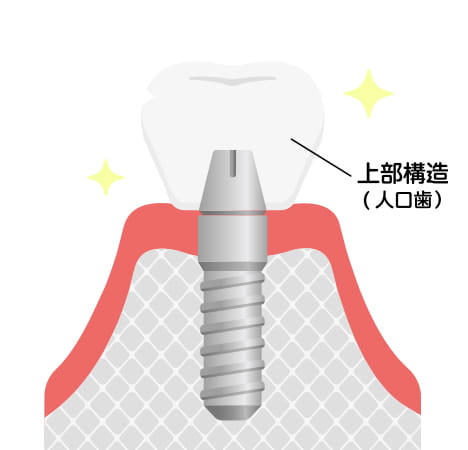 人工歯を装着