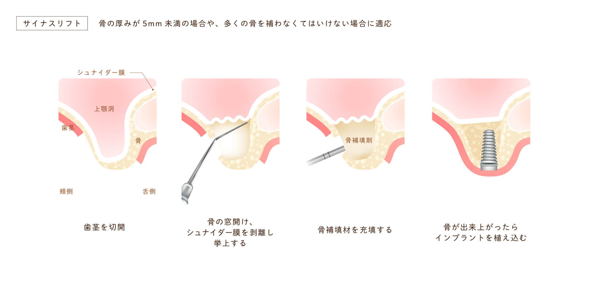 サイナスリフト