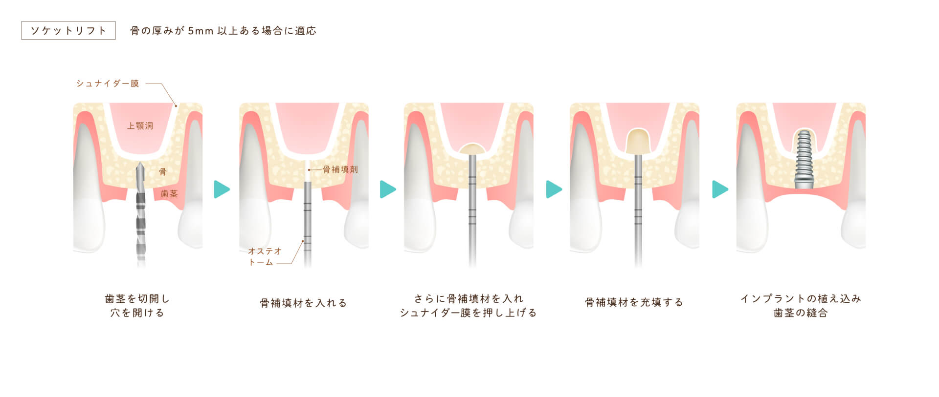 ソケットリフト