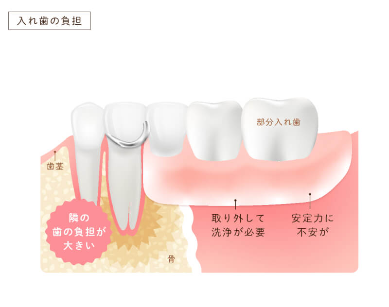 入れ歯負担