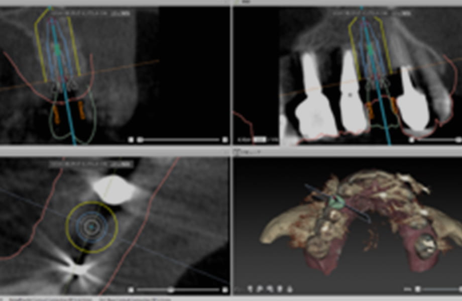 最新のインプラントナビゲーションシステム導入