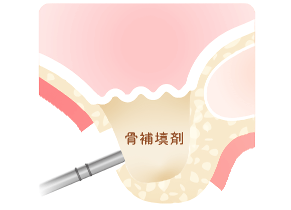 骨がない方も相談してください！骨造成という方法もあります