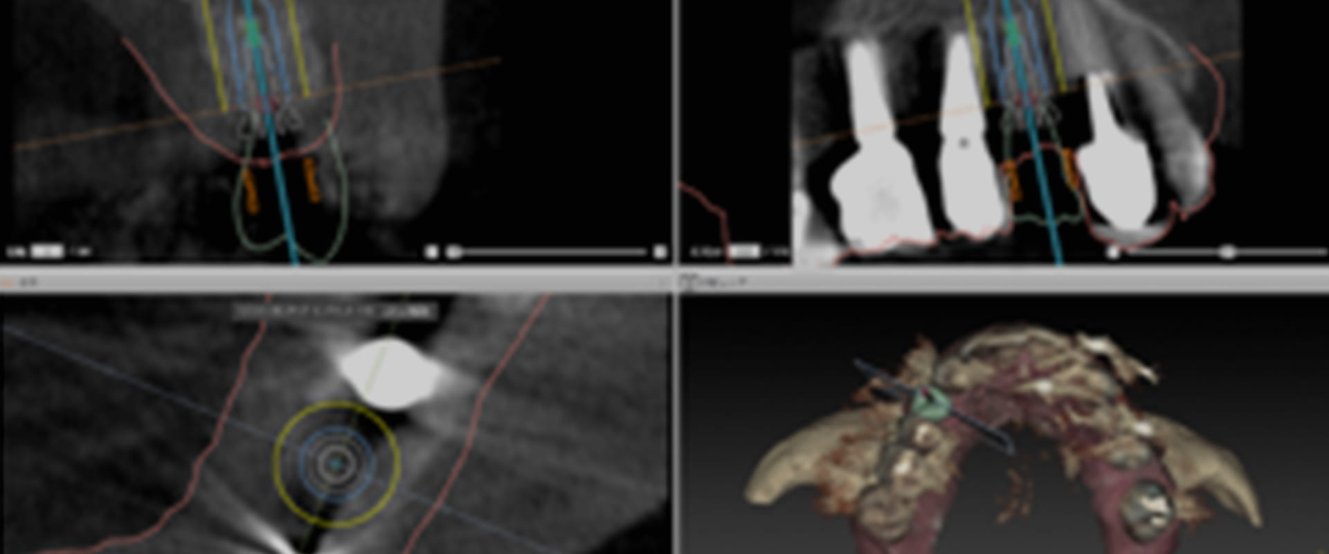 最新のインプラントナビゲーションシステム導入
